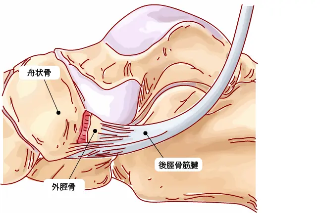 有痛性外脛骨と後脛骨筋腱