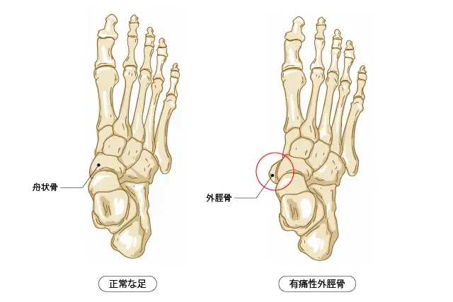 有痛性外脛骨とは