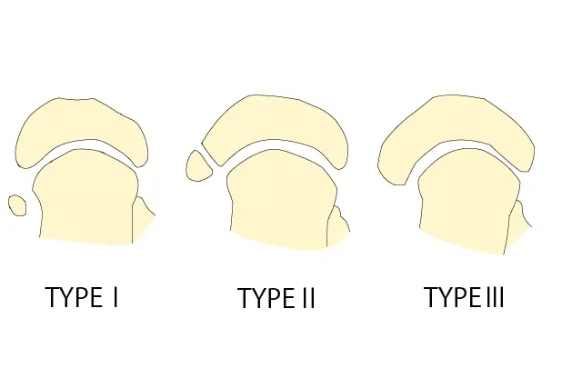 有痛性外脛骨のタイプ