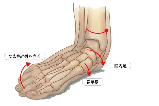 有痛性外脛骨テーピングの目的