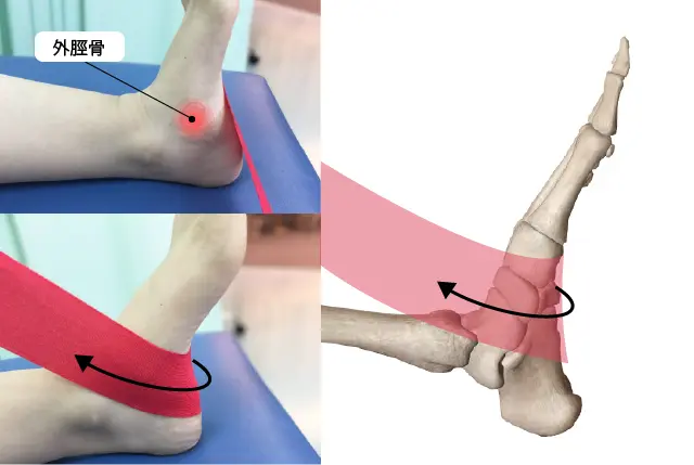 有痛性外脛骨テーピング①