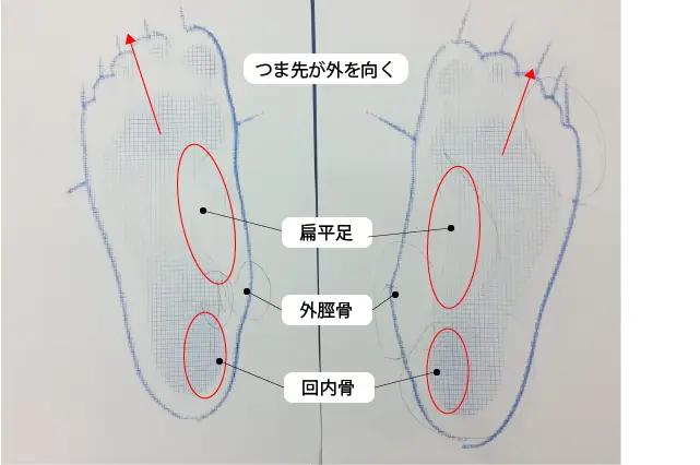 有痛性外脛骨のフットプリント