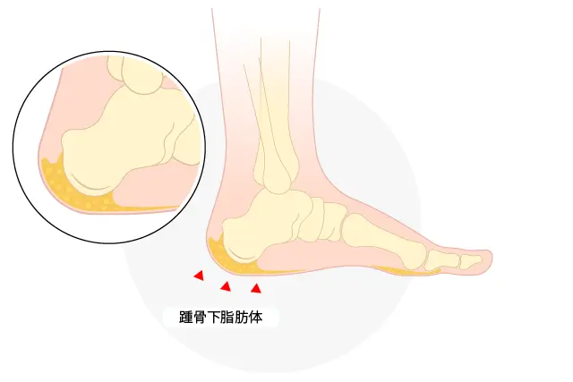 有痛性踵パッドとは