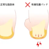 有痛性踵パッドとは