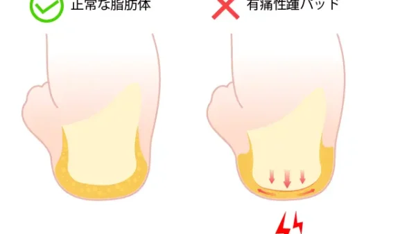 有痛性踵パッドとは？かかとの痛みの原因、症状、治療法