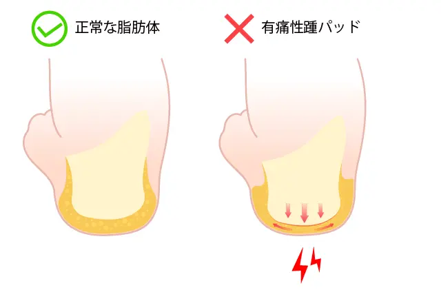 有痛性踵パッドとは