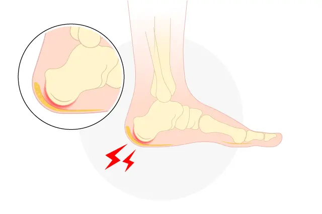 有痛性踵パッドとは②