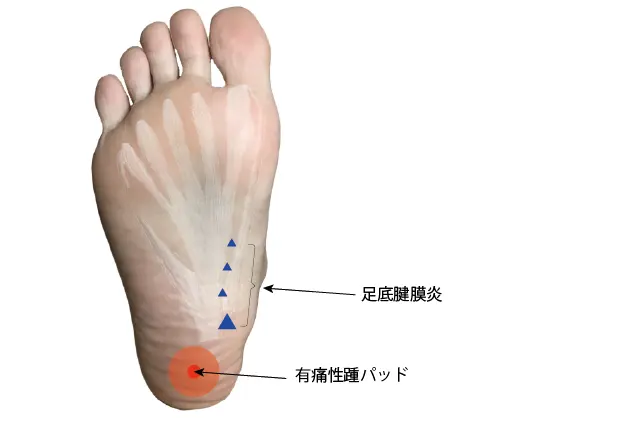 有痛性踵パッドと足底腱膜炎の圧痛点の違い