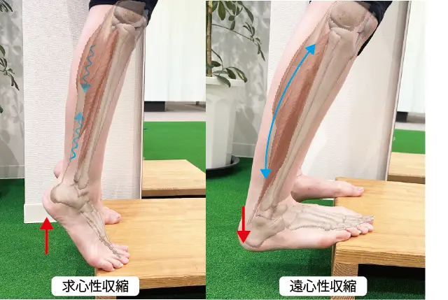 踵骨下滑液包炎に対するインソール