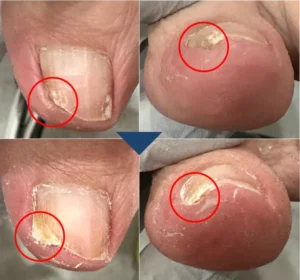 深爪before-after２