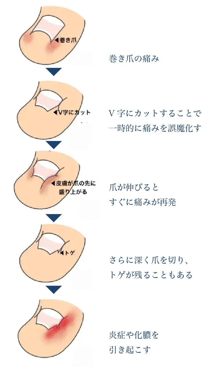 深爪スパイラル