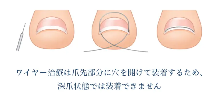 深爪状態ではワイヤー治療はできない