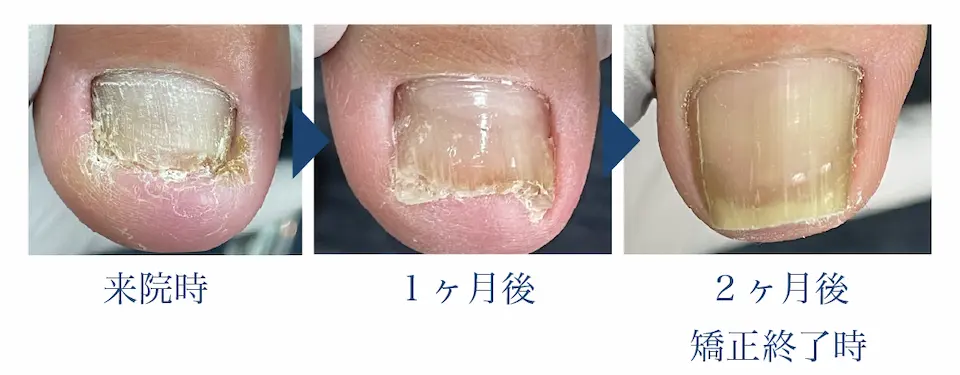 深爪矯正その後