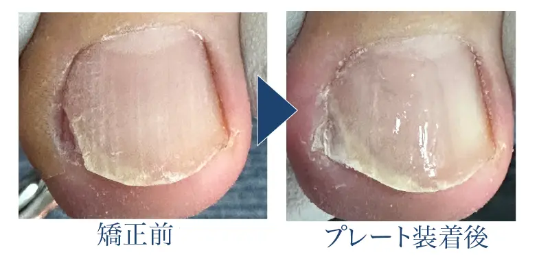 深爪矯正の効果２