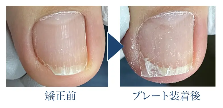 深爪矯正の効果３