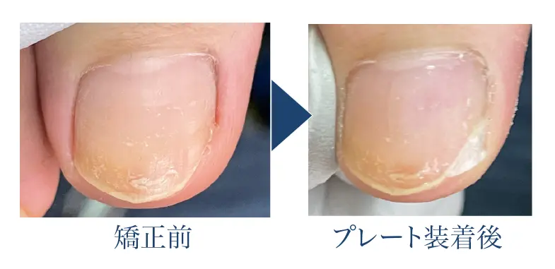 深爪矯正の効果４