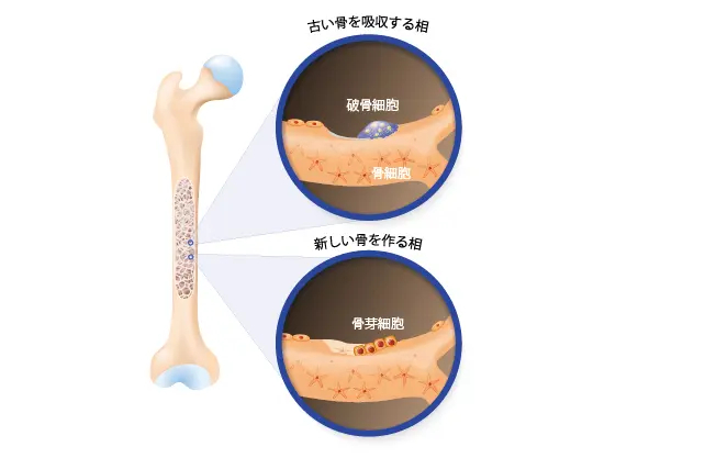 疲労骨折のメカニズム