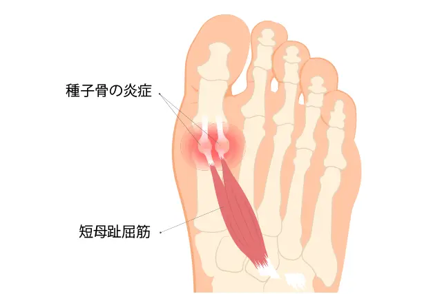 種子骨障害とは