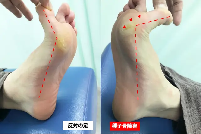 種子骨にかかる繰り返し負荷