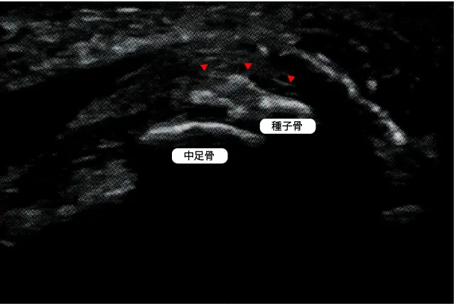 足底腱膜炎エコー検査