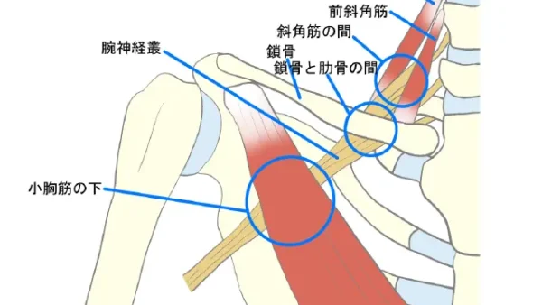 胸郭出口症候群の原因や治療法【金沢市アルコット接骨院】