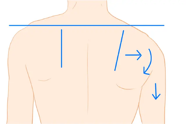 胸郭出口症候群牽引型の原因