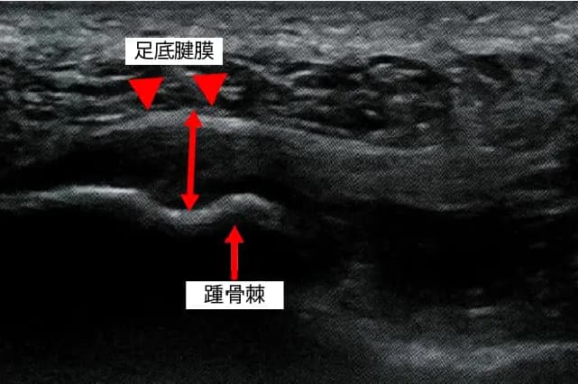 足底腱膜炎エコー２