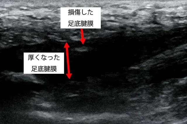 損傷した足底腱膜