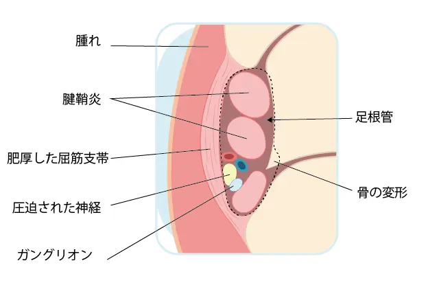 Jones骨折の原因