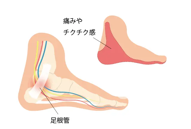 足根管症候群