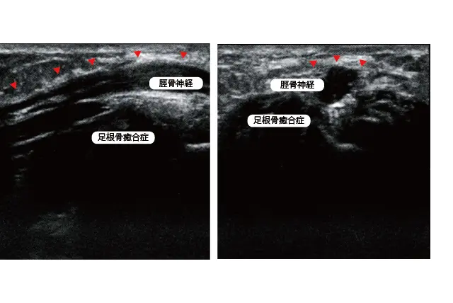 足根管症候群エコー画像