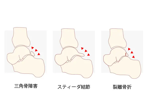 足関節後方インピンジメント症候群（骨性の制限）