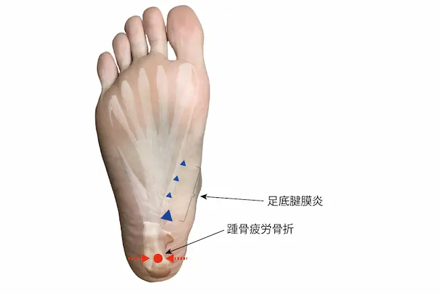 踵骨疲労骨折と足底腱膜炎の圧痛点の違い