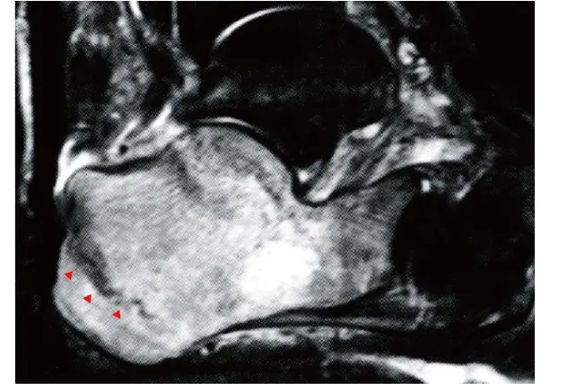 踵骨疲労骨折のMRI