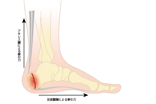 踵骨疲労骨折のメカニズム