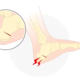 踵骨疲労骨折：原因、症状、治療法と最新の治療アプローチ