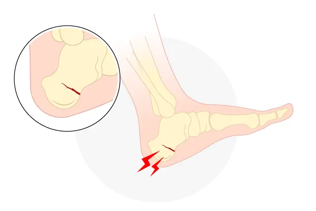 踵骨疲労骨折イラスト
