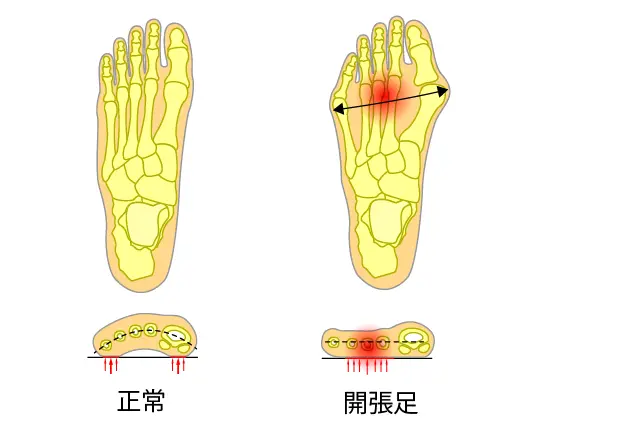 足のアーチの説明