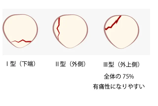 分裂膝蓋骨の分類