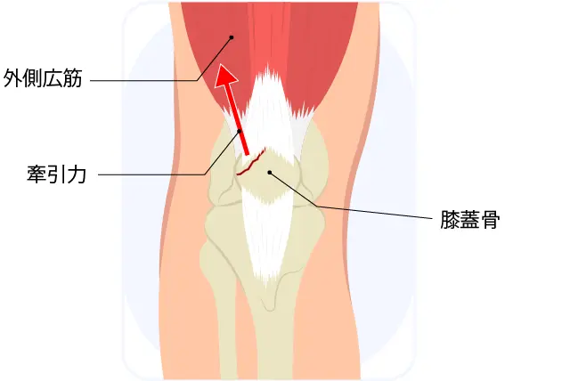 分裂膝蓋骨の原因