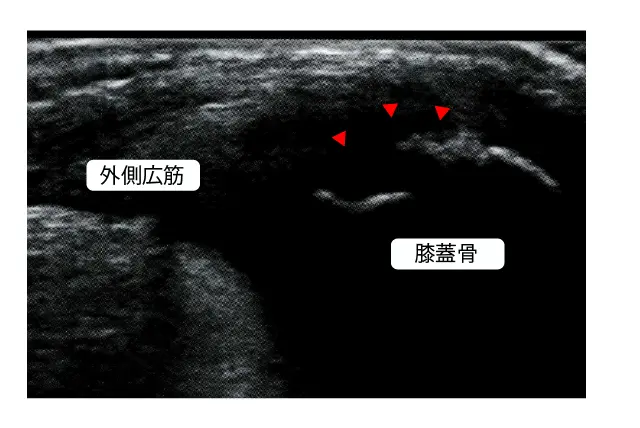 分裂膝蓋骨エコー検査