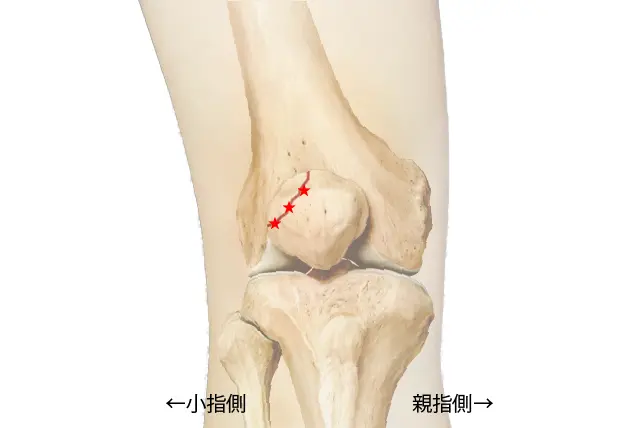 分裂膝蓋骨圧痛部位