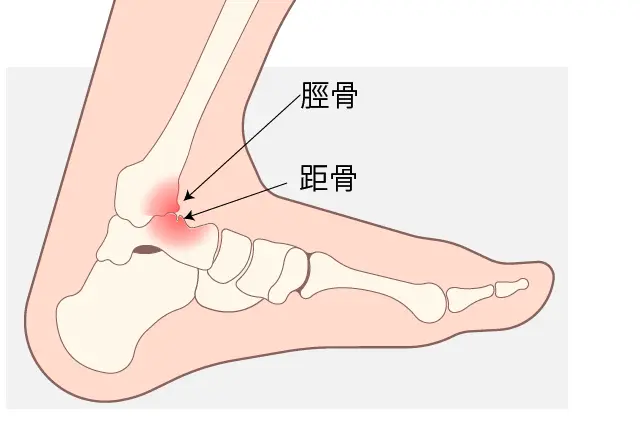 足関節前方インピンジメント症候群