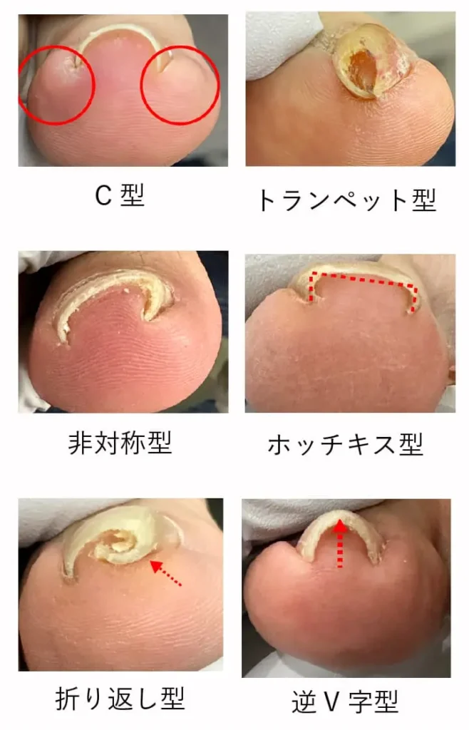 さまざまな巻き爪のタイプ