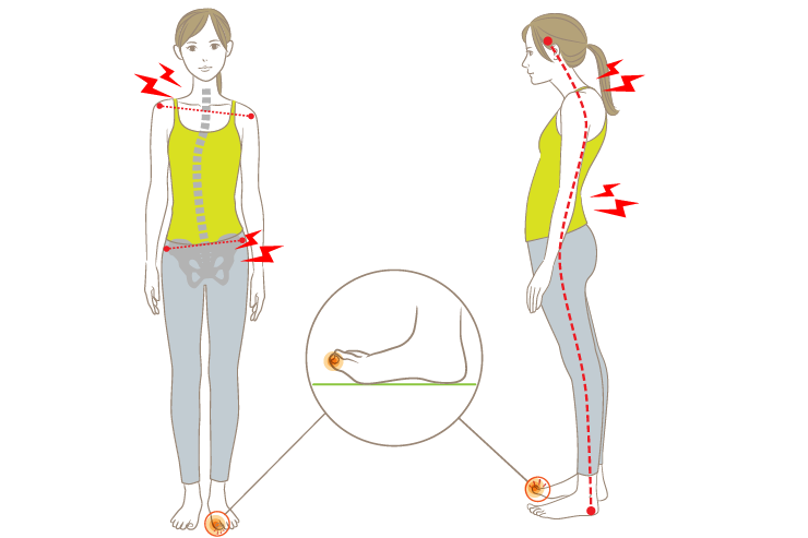 巻き爪が腰痛や肩こりの原因