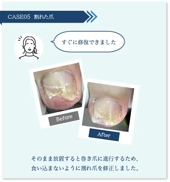 巻き爪スライダー5