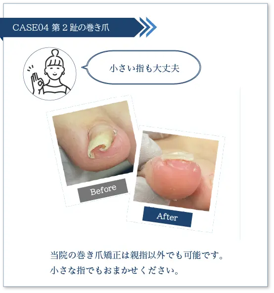 巻き爪スライダー④