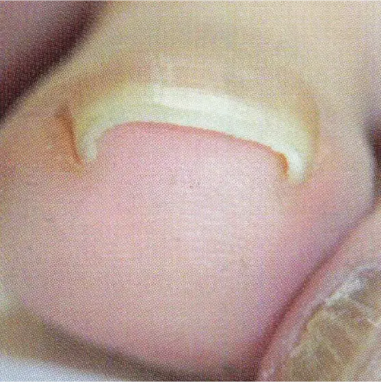 ホッチキス型巻き爪の治療法