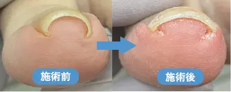 巻き爪ビュフォーアフター①１