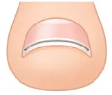巻き爪矯正①